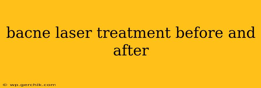 bacne laser treatment before and after