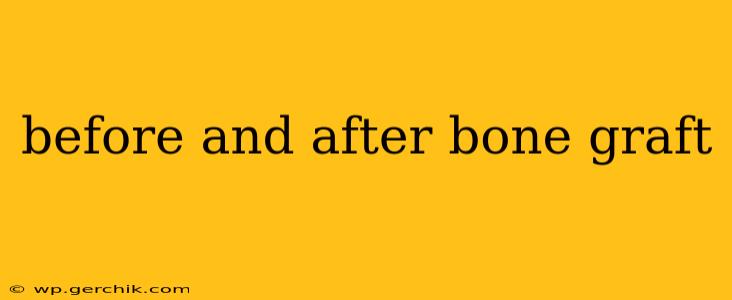 before and after bone graft