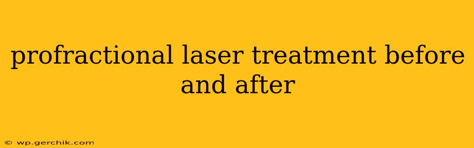 profractional laser treatment before and after