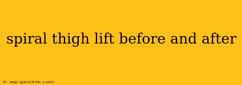 spiral thigh lift before and after